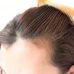 Hair Loss In Women