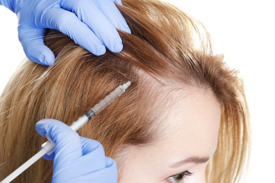 What You Need to Know About Prp Hair Treatment - HairFit Istanbul