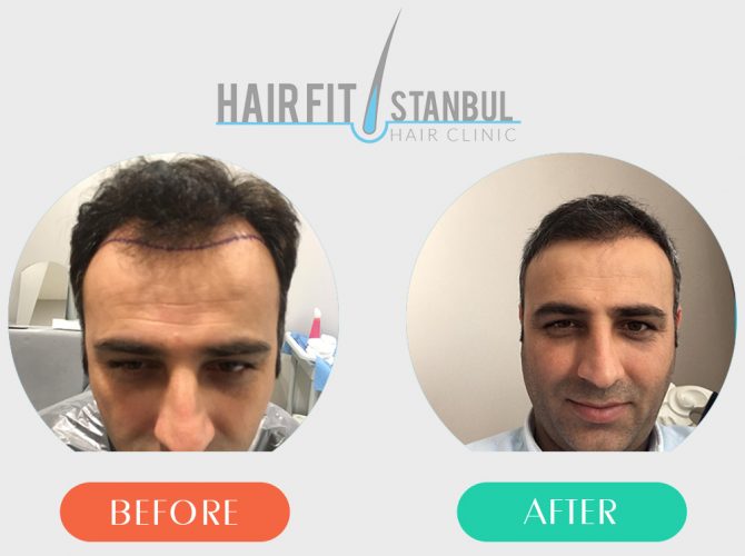 Hair Transplantation Before After