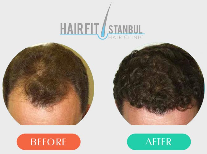 Hair Transplantation Before After