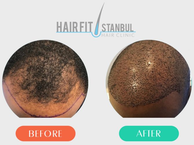 Hair Transplantation Before After