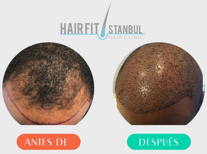 Trasplante de Cabello Antes Despues