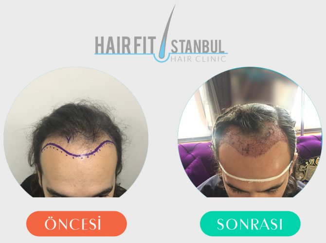 Saç Ekimi Öncesi Sonrası