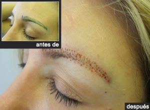 Trasplante de Cejas