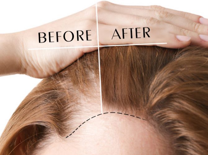 Hair Transplantion For Ladies