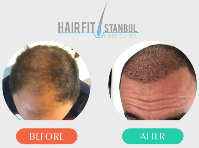 Hair Transplantation Before After