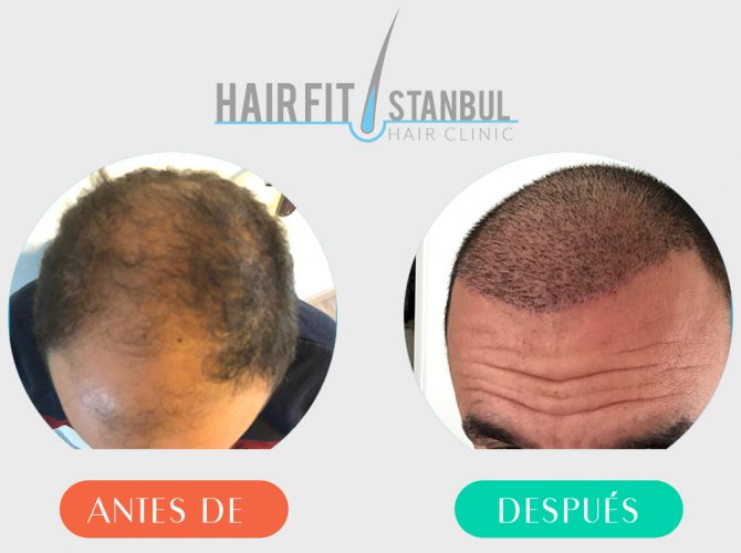 Trasplante de cabello antes despues