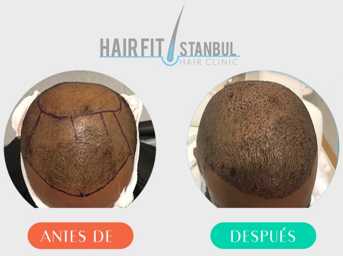 Trasplante de Cabello Antes Despues