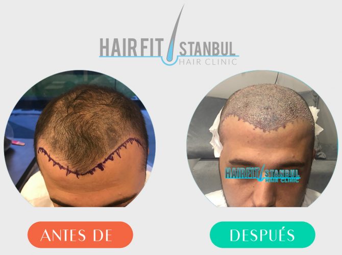 Trasplante de Cabello Antes Despues