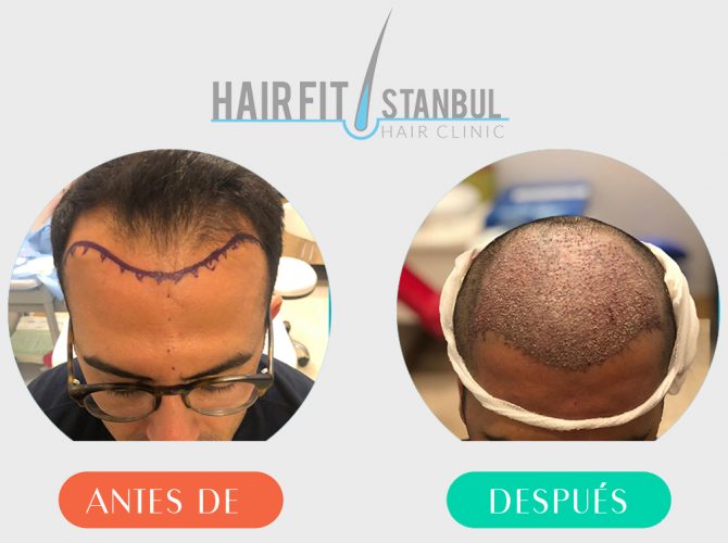 Trasplante de cabello antes despues