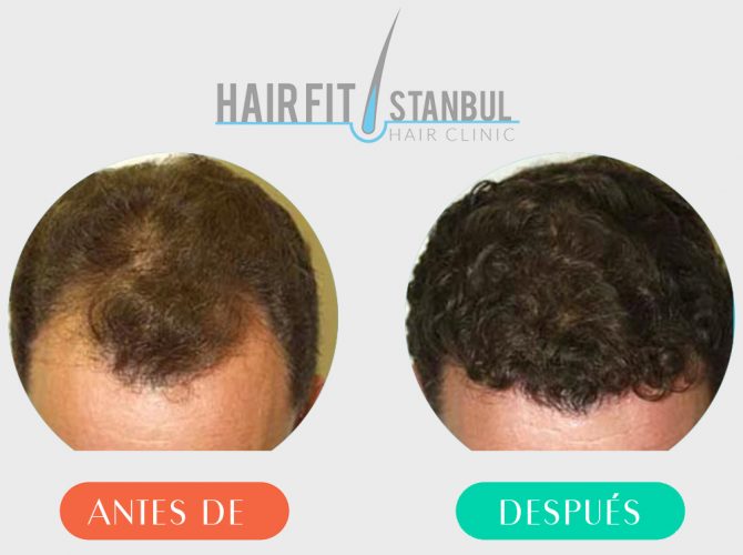 Trasplante de cabello antes despues