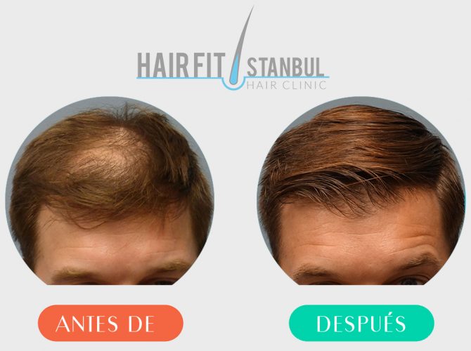 Trasplante de cabello antes despues