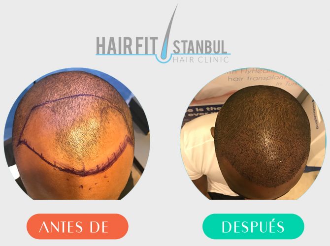 Trasplante de cabello antes despues