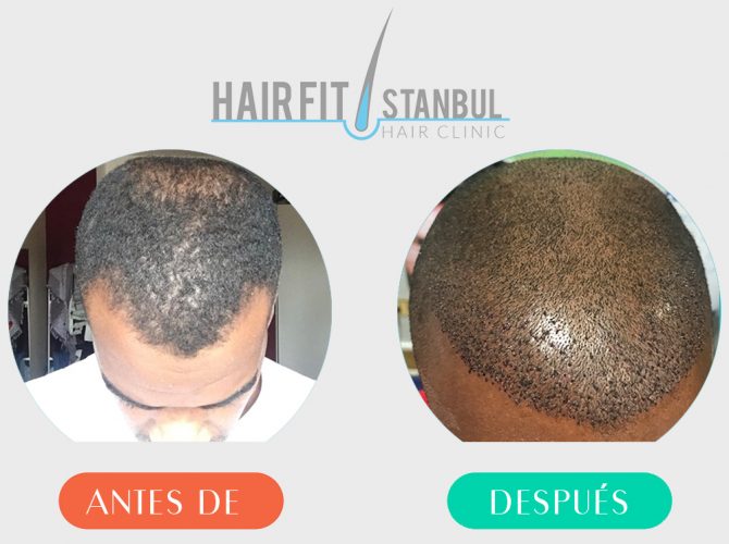 Trasplante de Cabello Antes Despues